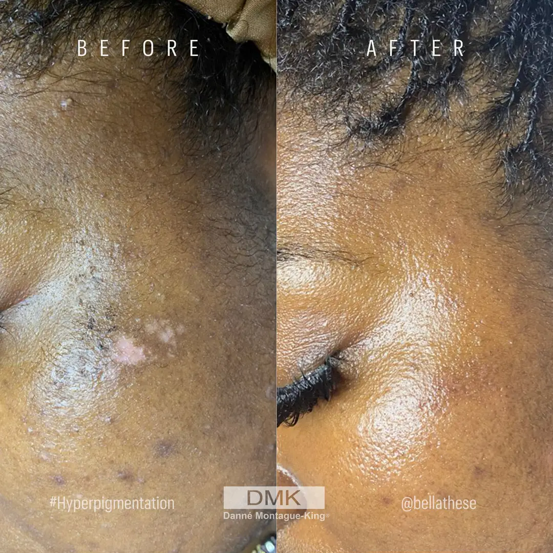 @bellathese_actrolbetagel_hyperpigmentation