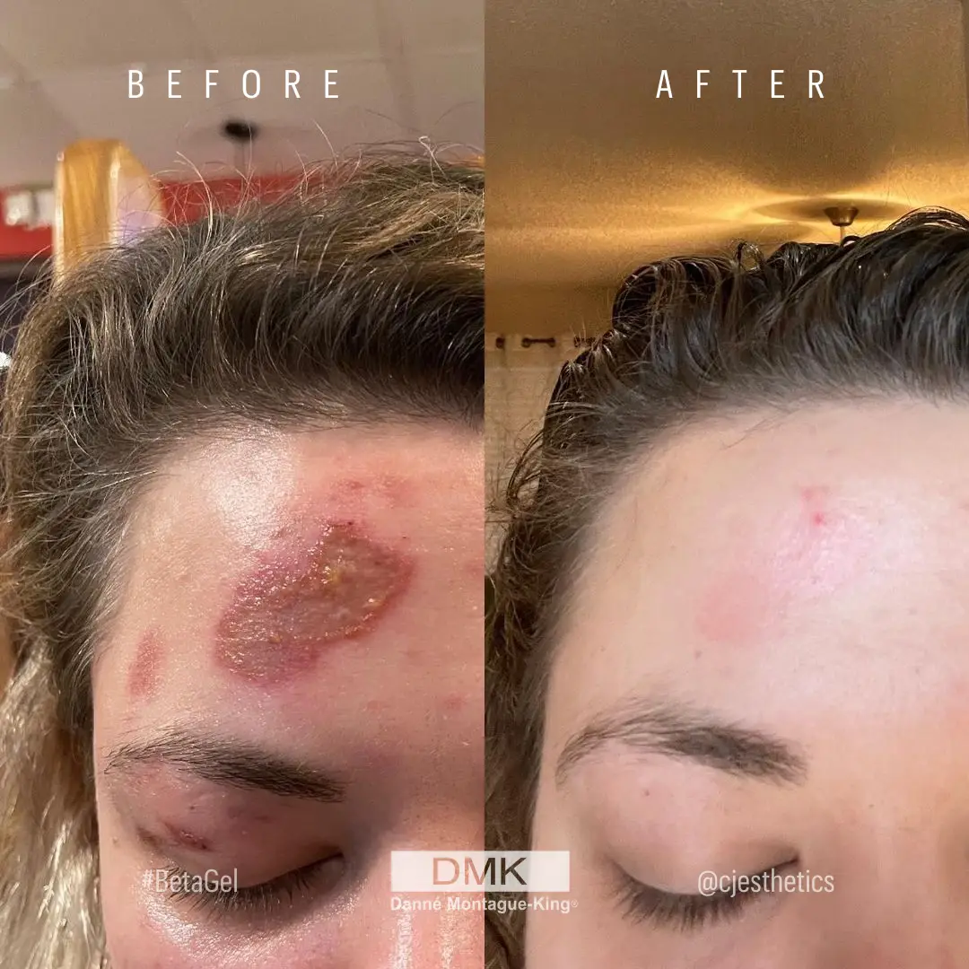 @cjesthetics-13-Days-Beta-Gel-Actrol-Powder-Skin-DamageBurn-BA-2-1