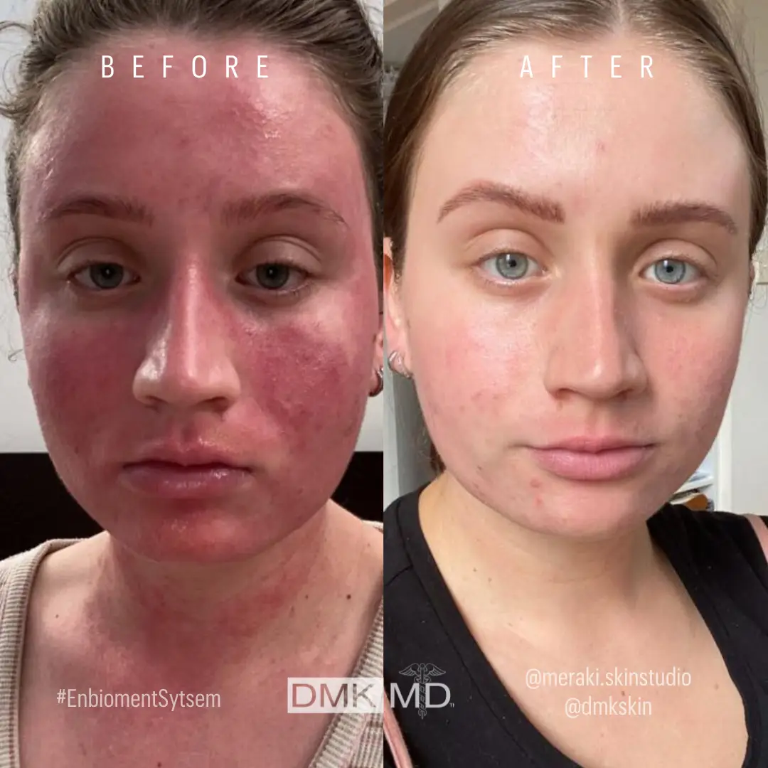 @dmkskin-DMKDifference-Home-Prescriptives-for-Perioral-Dermatitis-BA-1