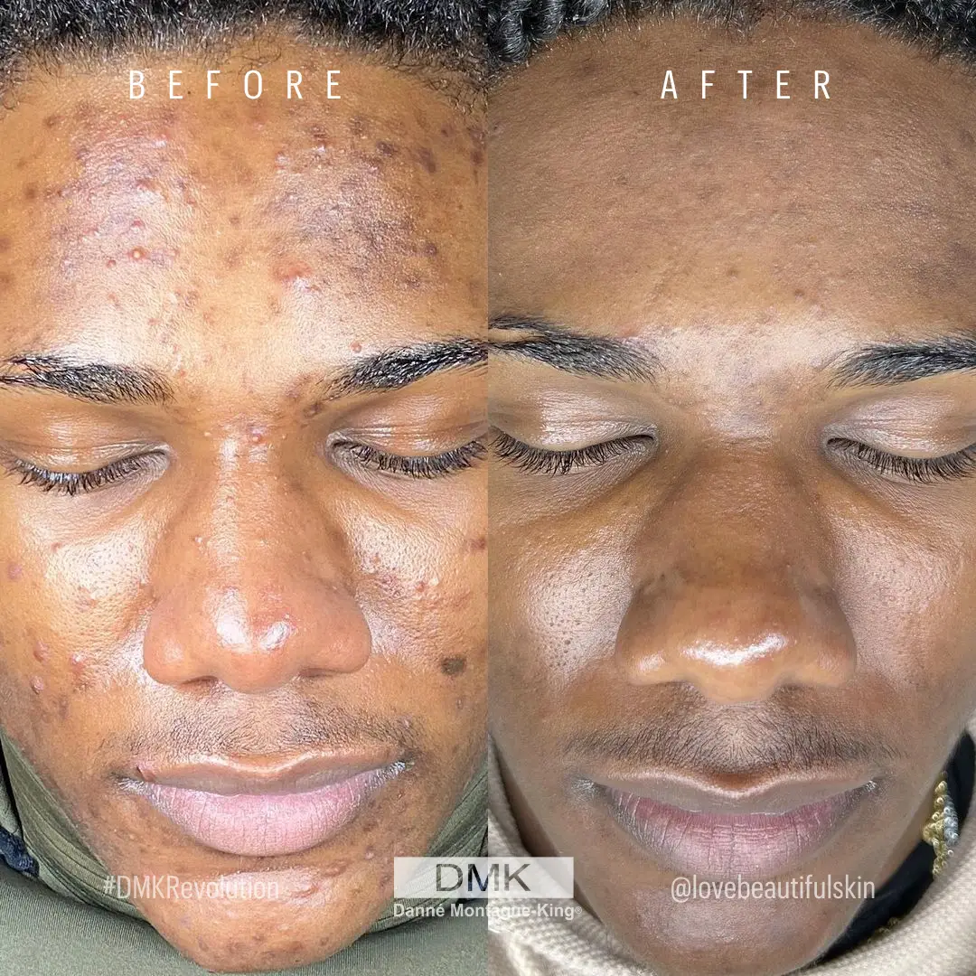 @lovebeautifulskin-by-Christina-DMKDifference-Acne-Hyperpigmentation-for-Melanated-Client-2-1