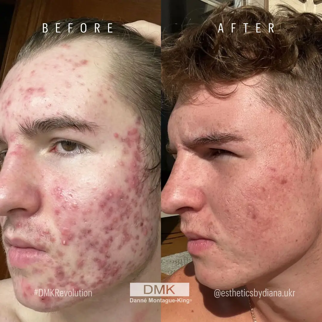@proesthetician-@estheticsbydiana.ukr-DMK-Acne-14-Month-BA-